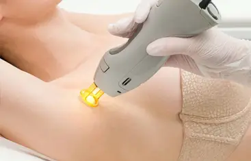 epilation laser