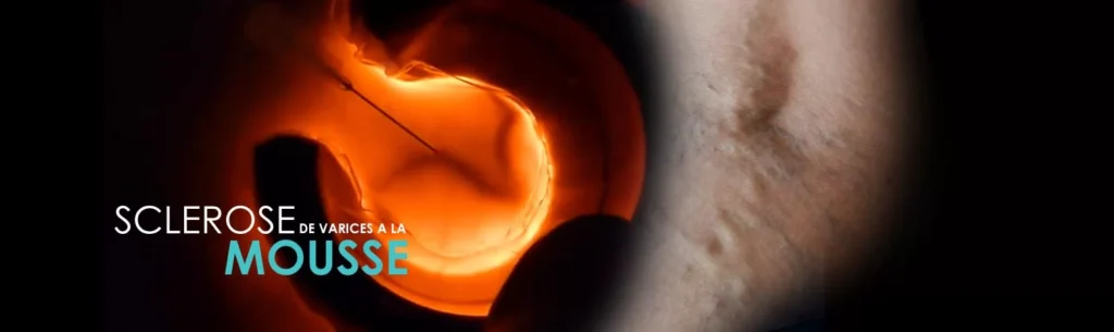 sclerose mousse des varices balaruc les bains