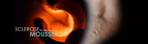 sclerose mousse des varices balaruc les bains