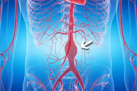 Anévrisme de l’aorte abdominale