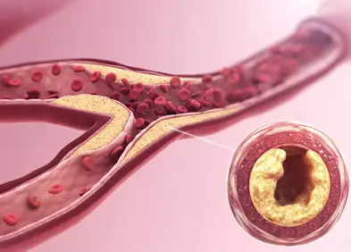 Artériopathie des membres inférieurs, cervicale et rénale