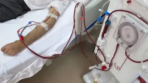 Fistules artério-veineuses d’hémodialyse