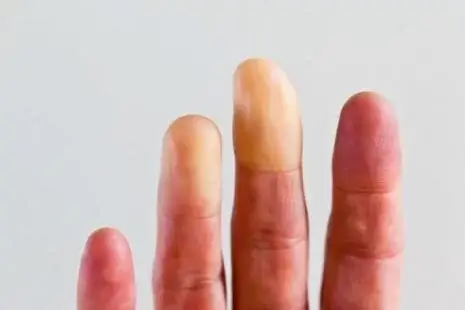 Les Acrosyndromes - Syndrome de Raynaud