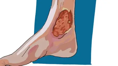 Ulcères de jambe d’origine vasculaire