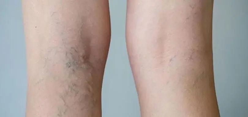 Varices des membres inférieurs