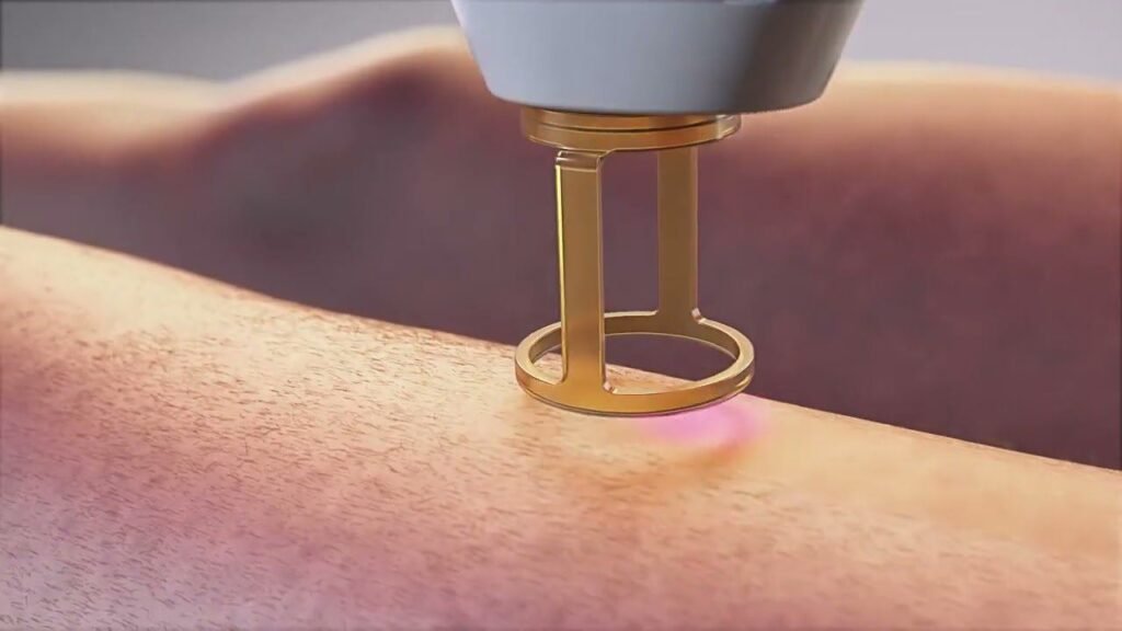 Traitement laser des varicosités au cabinet